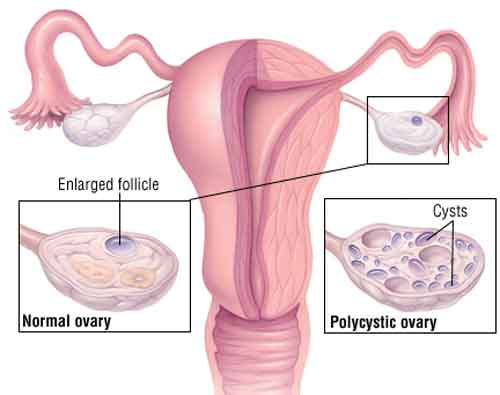Sindrome dell ovaio policistico cosè e come si cura